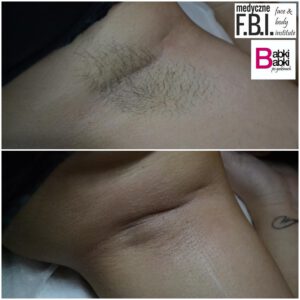 Depiluj, wstydu oszczędź! – Face and Body Institute