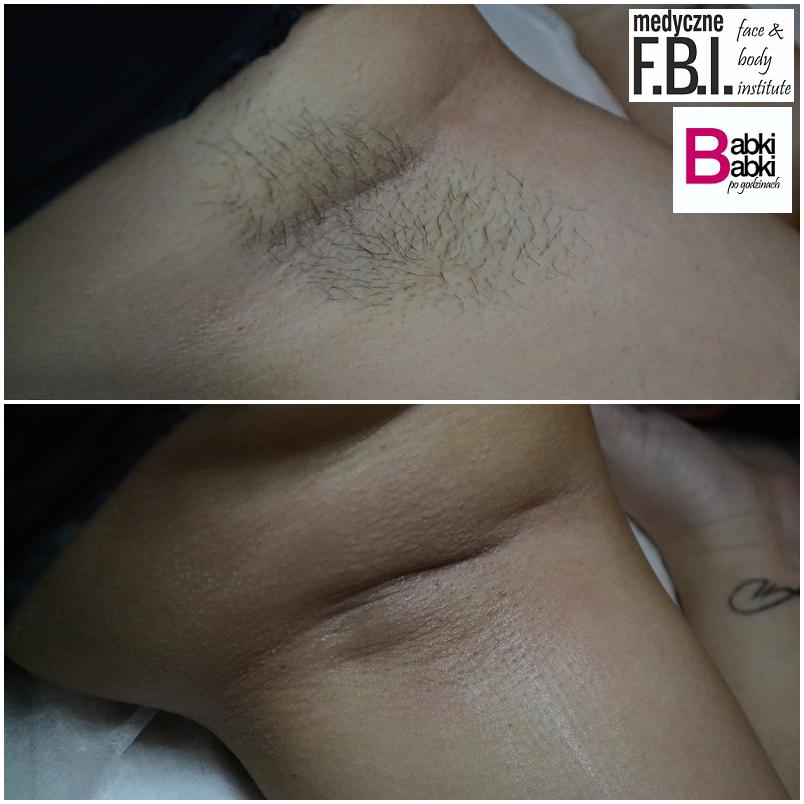 Depiluj, wstydu oszczędź! – Face and Body Institute