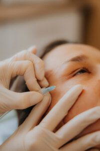 Mezoterapia igłowa - zabieg na twarz w Face and Body Institute