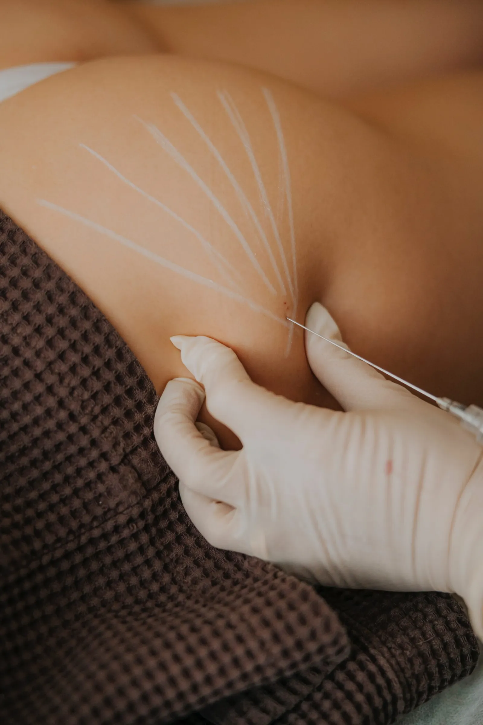 Body contouring with hyaluronic acid