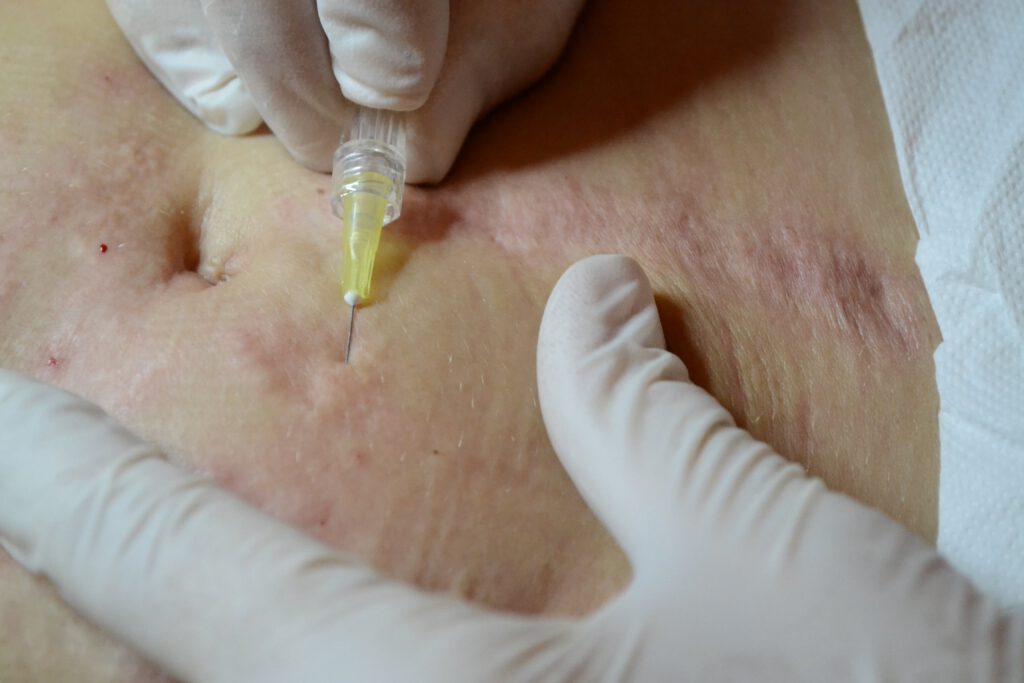 Mezoterapia osoczem bogatopłytkowym czyli cerujemy brzuch. – Face and Body Institute