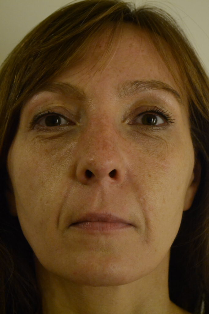 Kwas polimlekowy, strzykawki, znieczulenie…operacja na miarę piękna. – Face and Body Institute