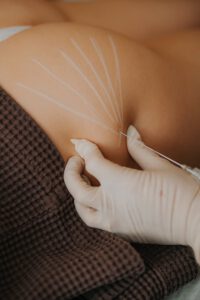 Konturowanie ciała kwasem hialuronowym - Face & Body Institute