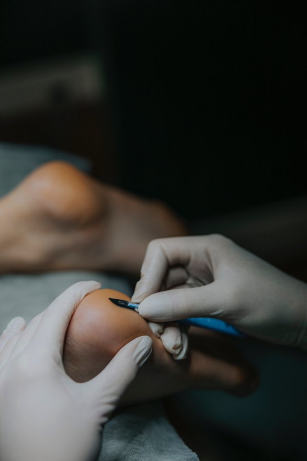 Pedicure stopy cukrzycowej